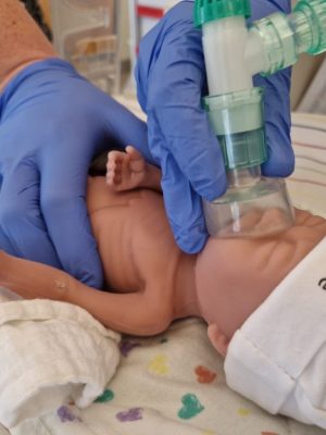 Nieuwe Nederlandse uitvinding redt pasgeboren baby’s die plots stoppen met ademen